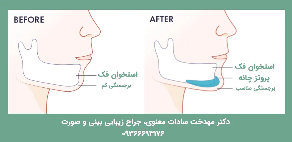 عکس قبل و بعد پروتز چانه